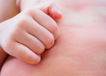 Podrażnienia skóry u noworodka – jak sobie z nimi radzić?